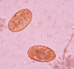 schistosomiasis infections