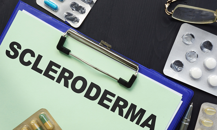 Conceptual photo showing printed text Scleroderma