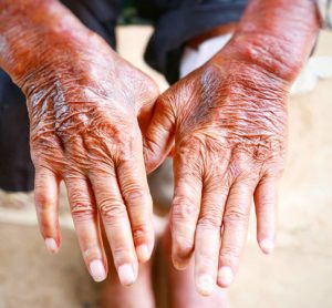 Image showing scleroderma patient's hands