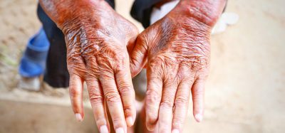 Image showing scleroderma patient's hands