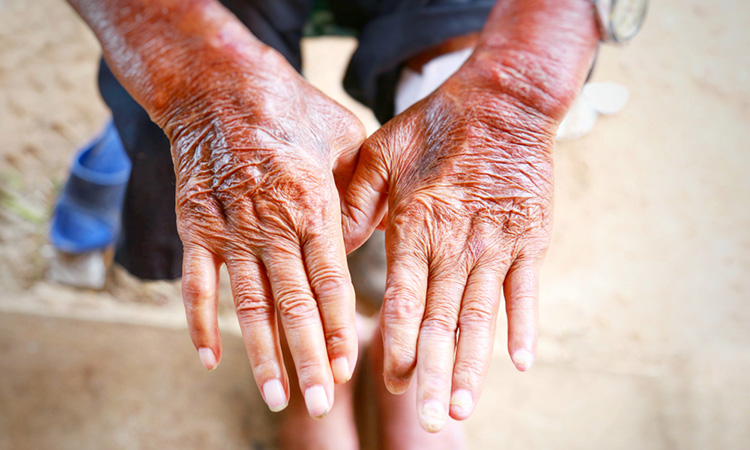 Image showing scleroderma patient's hands