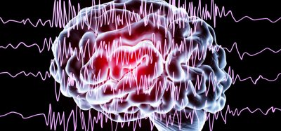 Brain with epilepsy