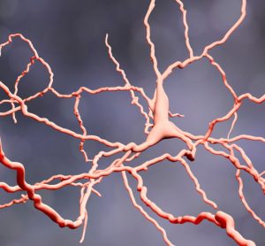 Huntington's disease neuron