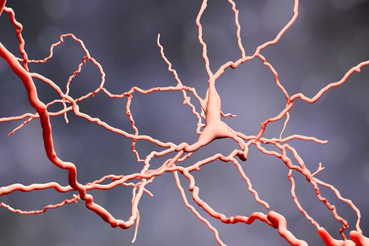 Huntington's disease neuron