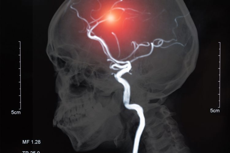 MRI scan of blood vessels in the brain