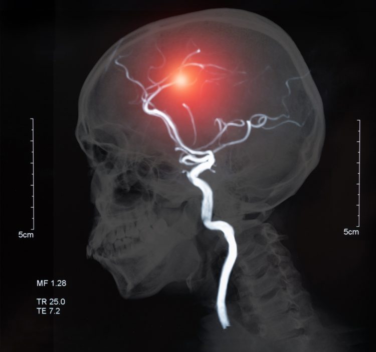 MRI scan of blood vessels in the brain