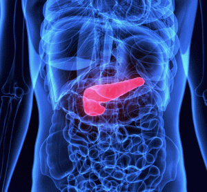 pancreatic cancer