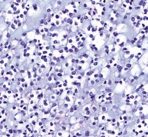 Magnified view of lioblastoma multiforme