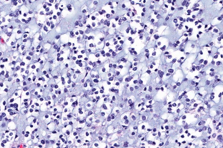 Magnified view of lioblastoma multiforme