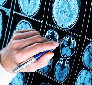 Doctor pointing pen at brain scan