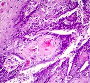 Carcinoma