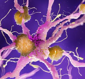 Amyloid plaques on neuron