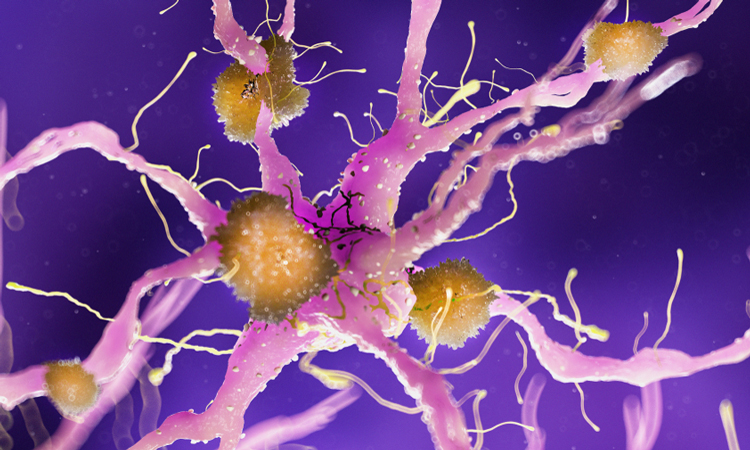 Amyloid plaques on neuron