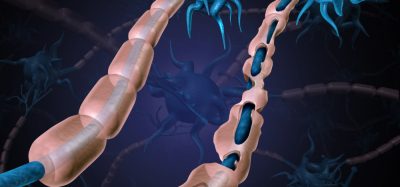 Healthy nerve next to nerve with damaged myelin, indicating multiple sclerosis