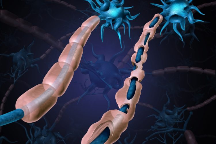 Healthy nerve next to nerve with damaged myelin, indicating multiple sclerosis