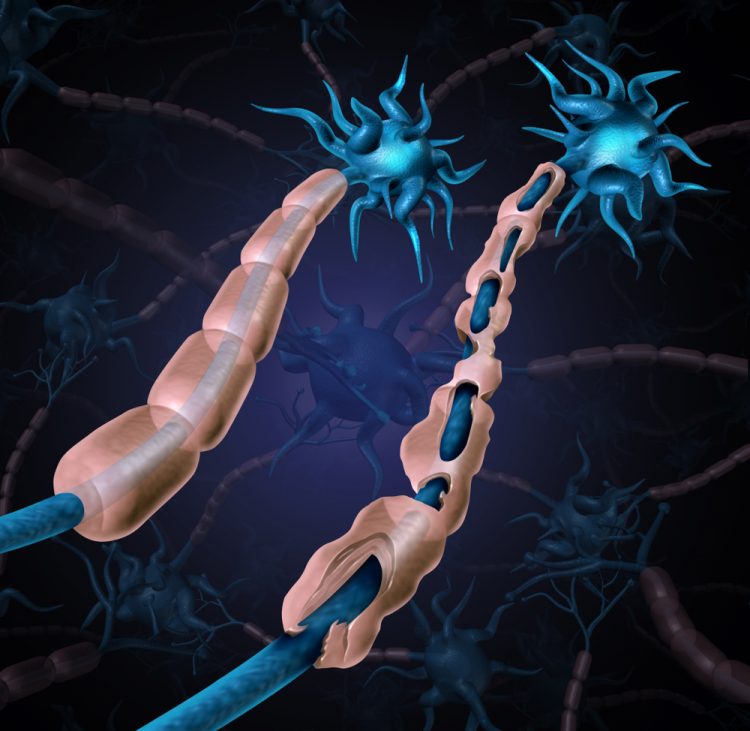 Healthy nerve next to nerve with damaged myelin, indicating multiple sclerosis