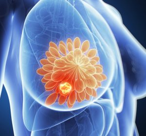 blue torso of a woman with a breast cancer tumour highlighted in glowing red