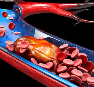 Thrombosis - blood clot
