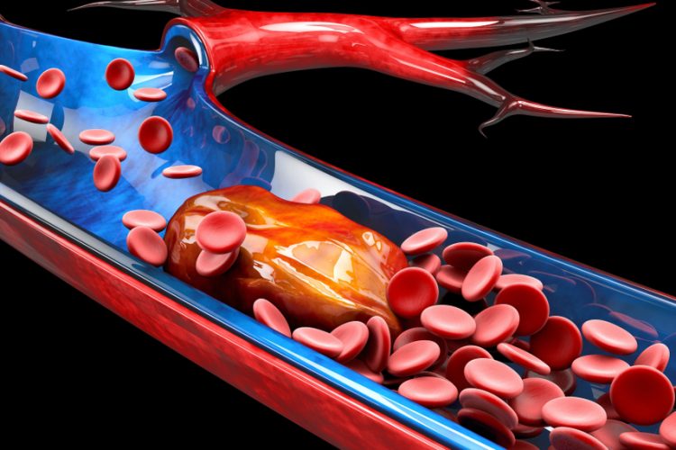 Thrombosis - blood clot
