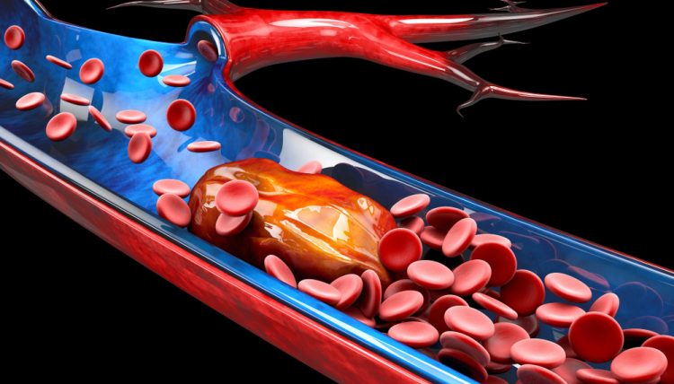 Thrombosis - blood clot