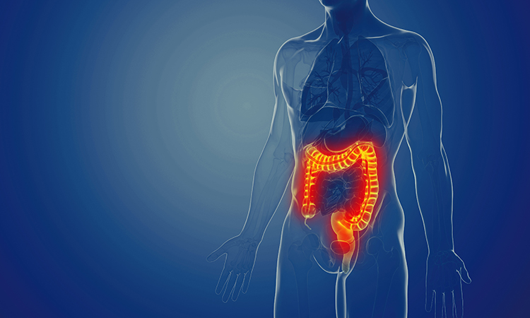 inflammatory bowel disease (IBD)