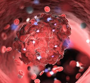 Blood clot in heart attack