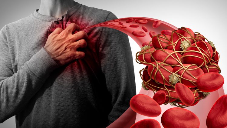 Illustration of blood clot with man holding chest in the background