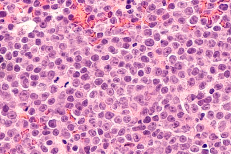 Microscopic view of lymphoma