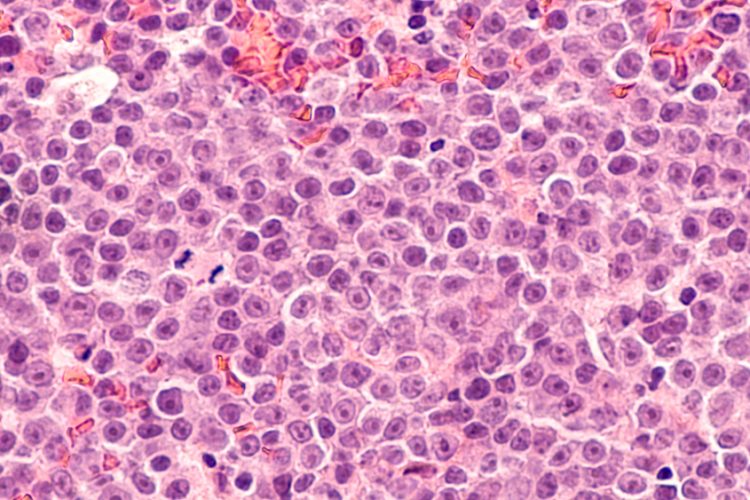 Microscopic view of lymphoma