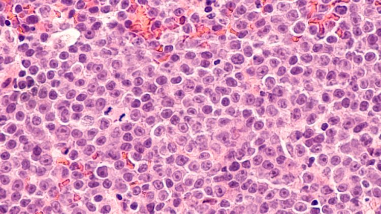 Microscopic view of lymphoma