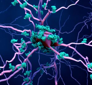 Amyloid fibrils around neurons