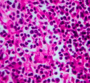 Magnified non-Hodkin's lymphoma