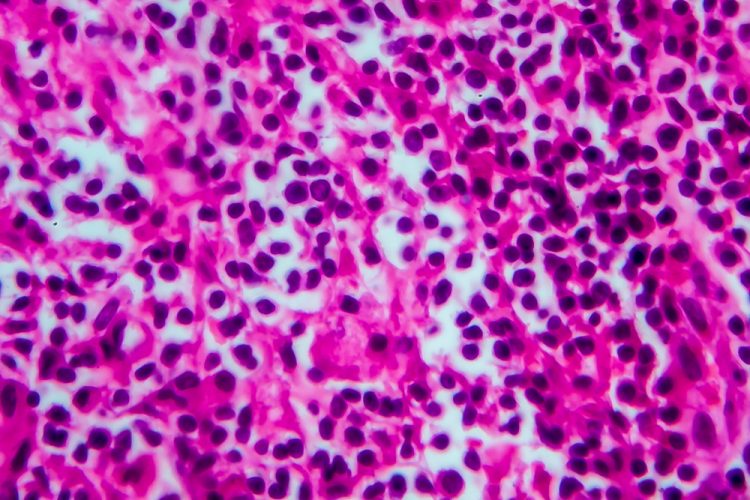 Magnified non-Hodkin's lymphoma