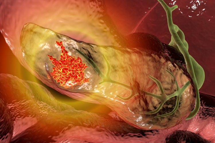 pancreatic cancer