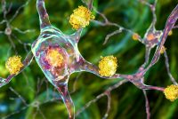 Neuronal inclusions in Huntington's disease, 3D illustration. Inclusions are composed of mutated huntingtin protein, they are initially formed at axons and dendrites, then migrate to nuclei of neurons