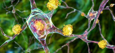 Neuronal inclusions in Huntington's disease, 3D illustration. Inclusions are composed of mutated huntingtin protein, they are initially formed at axons and dendrites, then migrate to nuclei of neurons