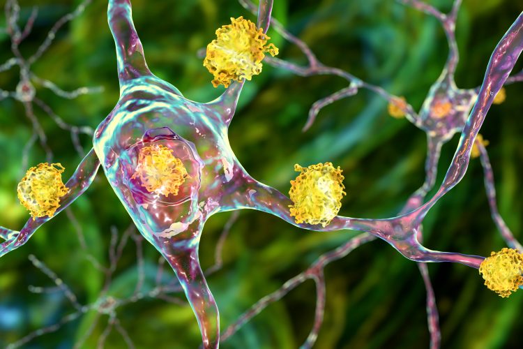 Neuronal inclusions in Huntington's disease, 3D illustration. Inclusions are composed of mutated huntingtin protein, they are initially formed at axons and dendrites, then migrate to nuclei of neurons