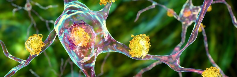 Neuronal inclusions in Huntington's disease, 3D illustration. Inclusions are composed of mutated huntingtin protein, they are initially formed at axons and dendrites, then migrate to nuclei of neurons