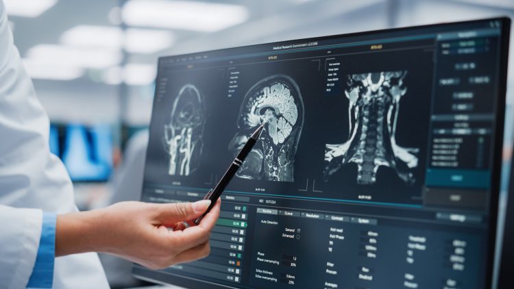 Neurologist pointing at brain MRI scans on a computer screen, illustrating the use of neuroimaging in central nervous system disease research.
