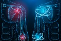 Digital illustration of human shoulder and elbow joints showing inflammation in red on the left side and healthy joints in blue on the right side, symbolizing immune-mediated inflammatory disease and treatment response