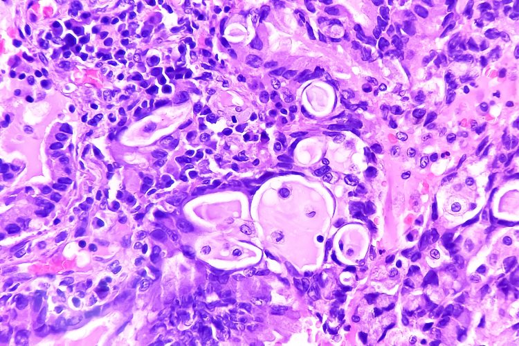 lung adenocarcinoma