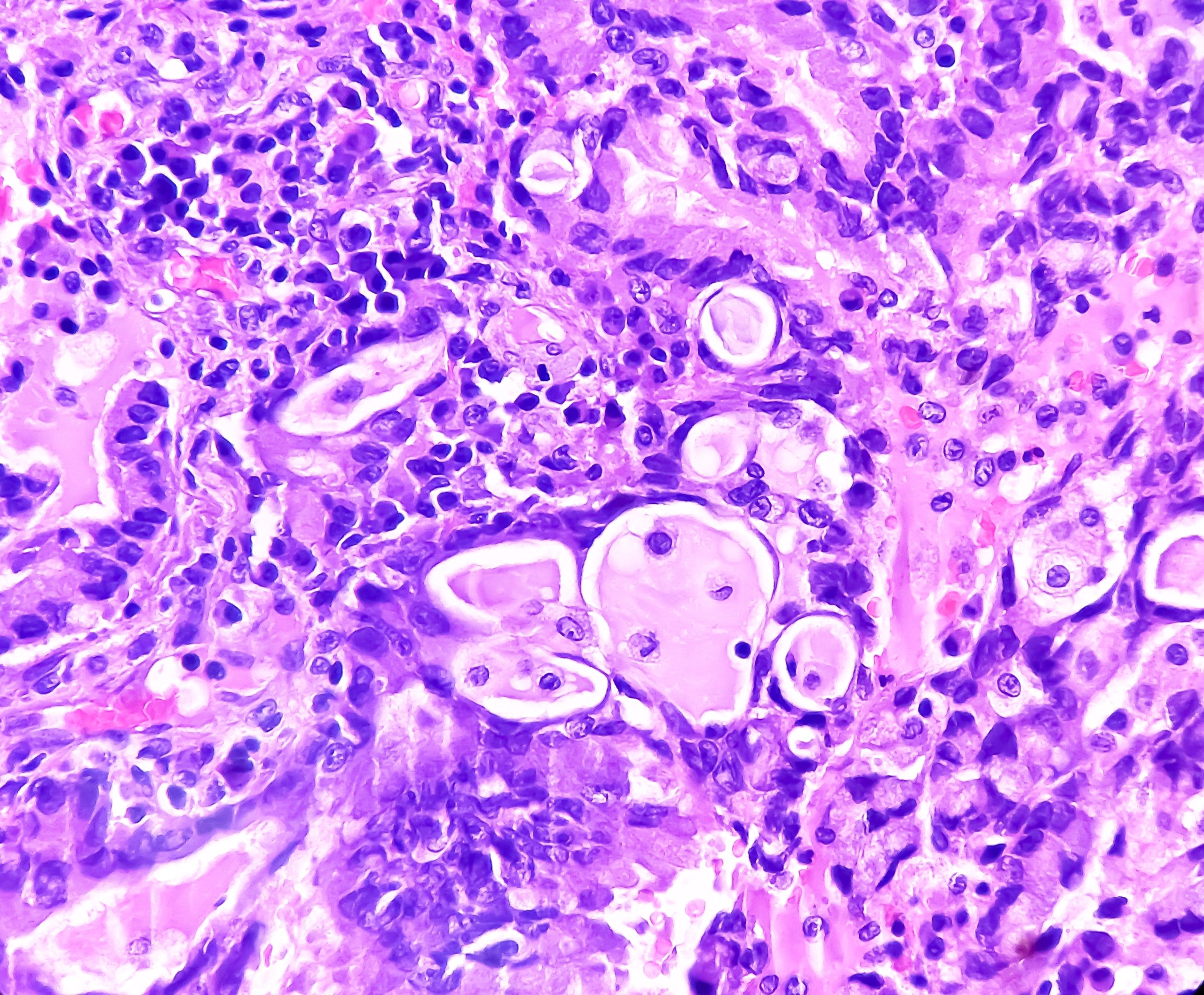 lung adenocarcinoma