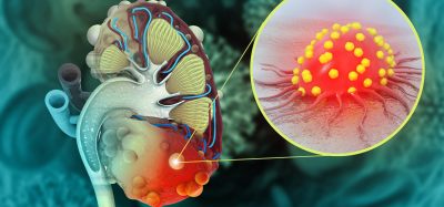 polycystic kidney disease