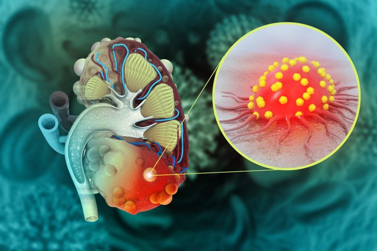 polycystic kidney disease