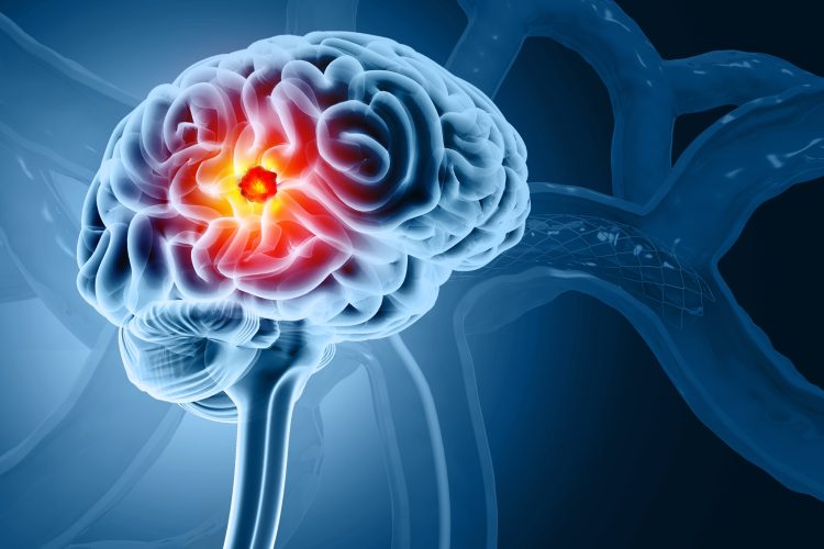 3D medical illustration of a human brain showing a glioblastoma tumour highlighted in red at the centre, representing its aggressive and infiltrative nature.
