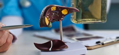 Alcoholic liver damage and liver cirrhosis concept with liver and alcohol. Cirrhosis by alcoholism hepatitis B or C or non-alcoholic fatty liver disease