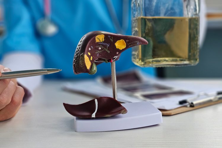 Alcoholic liver damage and liver cirrhosis concept with liver and alcohol. Cirrhosis by alcoholism hepatitis B or C or non-alcoholic fatty liver disease