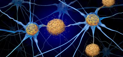 Illustration of neurons showing intracellular tau protein aggregates associated with tauopathies and neurodegenerative disease