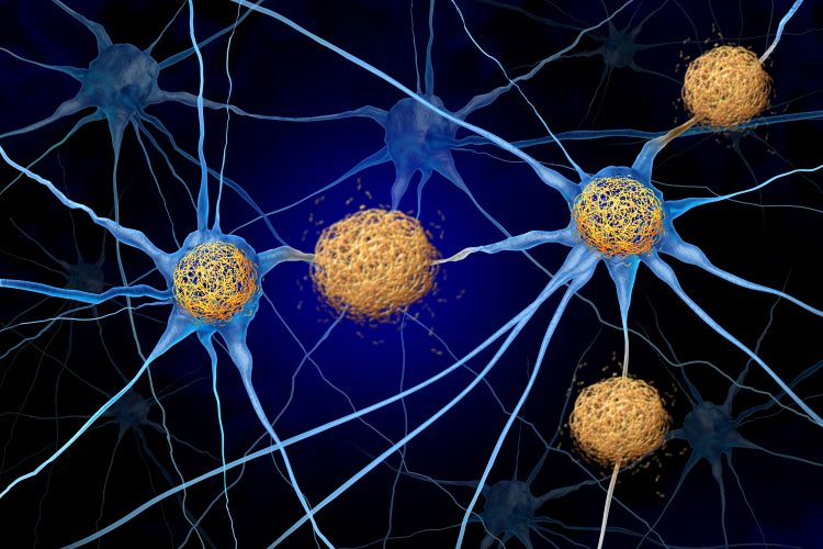 Illustration of neurons showing intracellular tau protein aggregates associated with tauopathies and neurodegenerative disease