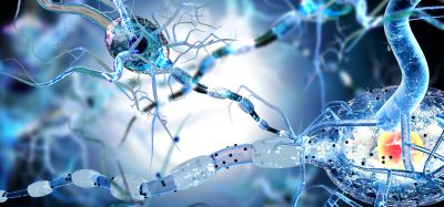 3D illustration of damaged neurons with disrupted myelin sheaths, representing neurodegeneration in conditions such as Alzheimer’s disease.